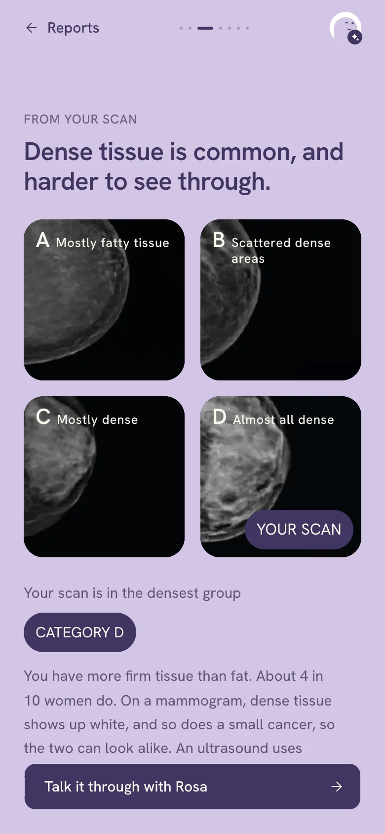 From your scan: Dense tissue is common, and harder to see through. Four pictures, the density groups A to D, from mostly fatty tissue to almost all dense, with Your scan marked on the fourth; the chip Category D; and the line that about 4 in 10 women have dense tissue, which shows up white on a mammogram, as a small cancer does.